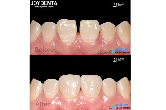 Proteção contra manchas de revestimento de porcelana Tratamento dentário revestimento de resina composta resistente a manchas