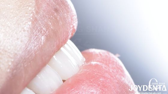 Beneficios de revestimento dentário composto de longa duração Boa biocompatibilidade Sem queda de revestimentos de porcelana
