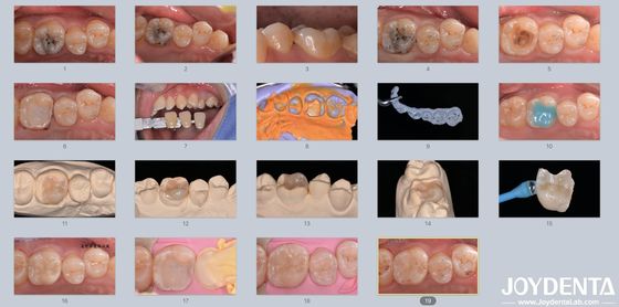 Adultos Crianças Inlaçamento Dental Cerâmico de Porcelana Restaurador para Dentes Danados