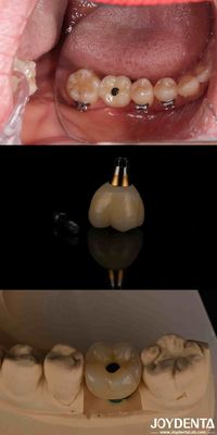 4-6 Dental Endosseous Conical Implant Subcrestal nível ósseo e conexão hexadecimal interna