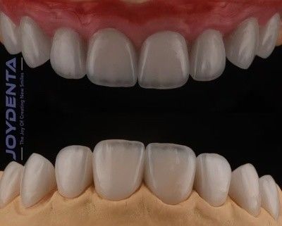 Veneers de porcelana cosmética com forte adesão.