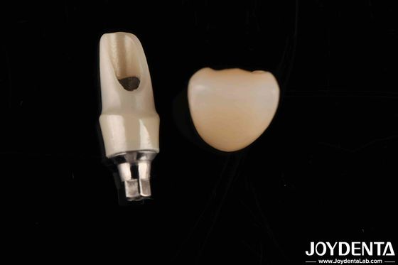 Circonia Abutments custom e barras Restaurações dentárias para anatomia individual do paciente