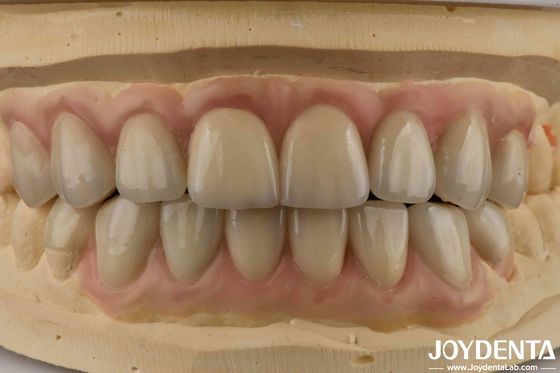 Alta translucidez Emax Cosmética Odontologia Veneers Alta estética Ultra fina