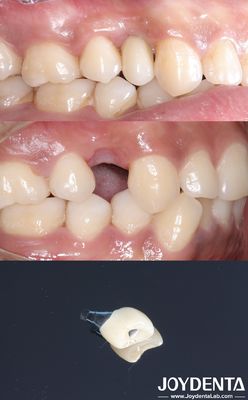 Todos em 4 Implante dentário de forma cilíndrica Titã Implante dentário superfície áspera
