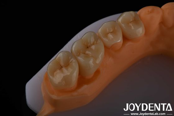 Alta estética Zirconia de contorno completo para coroas Pontes Implantes Restaurações dentárias