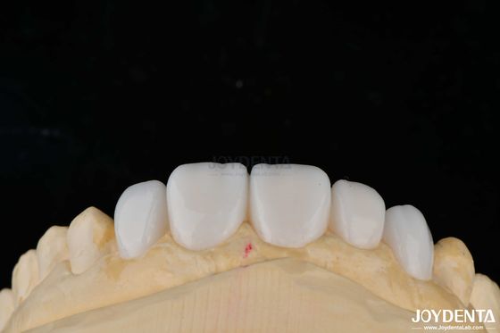 Materiais de porcelana de personalização Emax Veneers de dentes para ligação de alta estética
