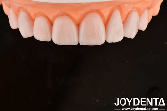 Fabricação sob medida IPS Porcelana Emax Veneers Restaurações dentárias Resistente a chipping