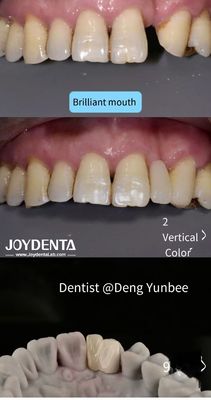 Dentes traseiros de Maryland Bridge ligados a resina para limpeza regular de fio dental