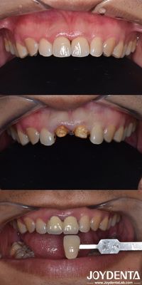 Técnica de preparação orientada biologicamente Preparação dental vertical Minimamente invasiva