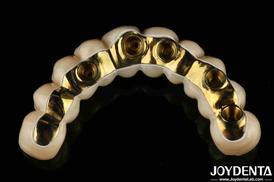 Prótese dentária de precisão feita sob encomenda