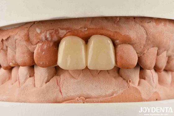 Polymethyl methacrylate de PMMA multicamadas para restaurações dentárias