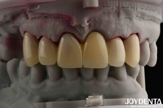 CAD CAM Processamento Dental PMMA Material Multilayer Design Para Transições de Sombra Natural
