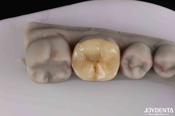 Preparação mínima para restauração dentária danificada