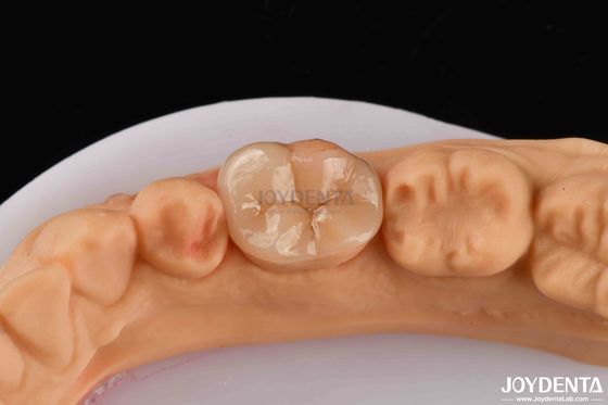 Alta Durabilidade Dental Inlay Onlay Composite Aparência Natural