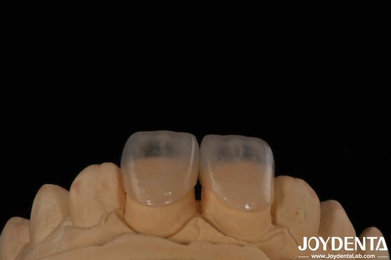 Eco Friendly Micro Dental Teeth Veneer 0.2mm espessura textura lisa