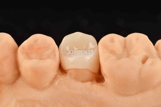 Inlay de composição branca personalizável Onlay de aparência natural Restauração dentária minimamente invasiva