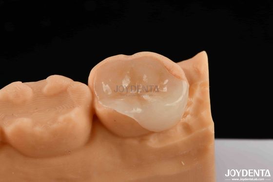 Porcelana polimerizada Incrustação e Instalação Compostas Restaurações Estéticas e Duráveis