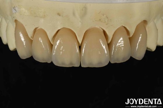 Excelente biocompatibilidade Zircônio em camadas com alta estética e densidade 6,0-6,1 G/cm3