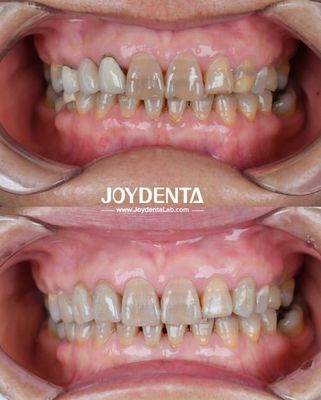 Circonia Dental Leve Para Experiência Ótima do Paciente Transições de Cor Naturais E Biocompatibilidade Garantida