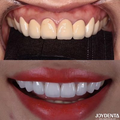 CAD/CAM Compativel Coroas Dentárias de Zircônia Fabricação de Precisão para Tons e Tamanhos Personalizados