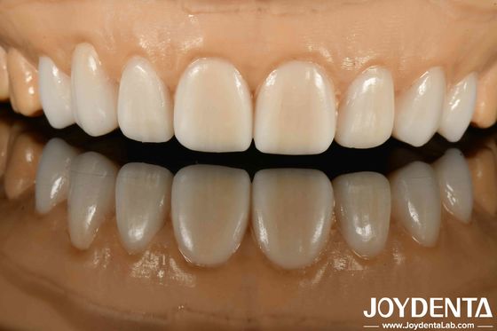Alto sigilo Materiais diversos de metais e resinas Dentura flexível para tecnologia avançada de sigilo