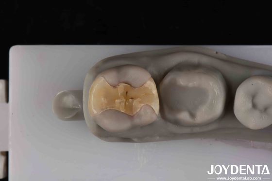Inlay Onlay Cementamento seguro de baixa translucidez para restaurações duradouras e estéticas