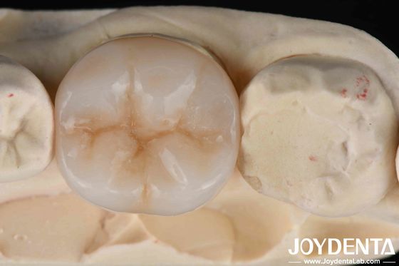 Multicamadas de zircônio completo A combinação definitiva de força e estética para restaurações dentárias