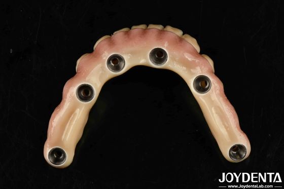 Ponte Híbrida de Titânio Malong Dental Durável Estético para Cuidados