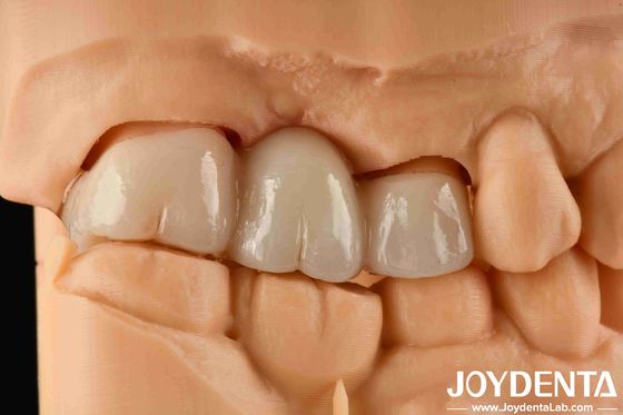 Experiência de cor realista Zirconia completa com alta resistência à mancha e resistência flexural de 1000 MPa