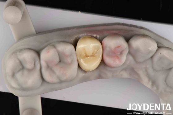 Duração de fractura 9 MPa·m1/2 Alta estética Alta resistência ao desgaste Zirconia completa