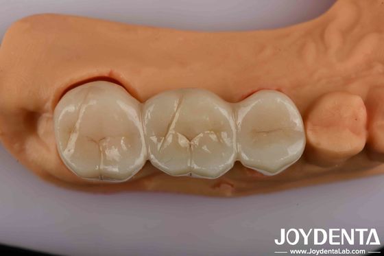 Zirconia Dental de Alta Força A Solução Última Para Estética Natural