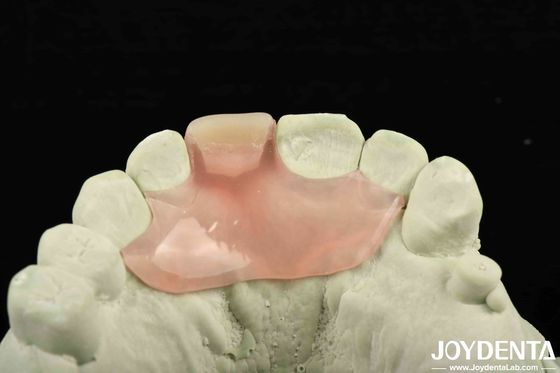 Personalização Flexível Dentura Finish usando a tecnologia de arranjo de dentes com boa elasticidade