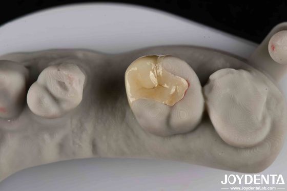 Forte resistência à fratura Emax Inlay Onlay Estética e durabilidade de aparência natural