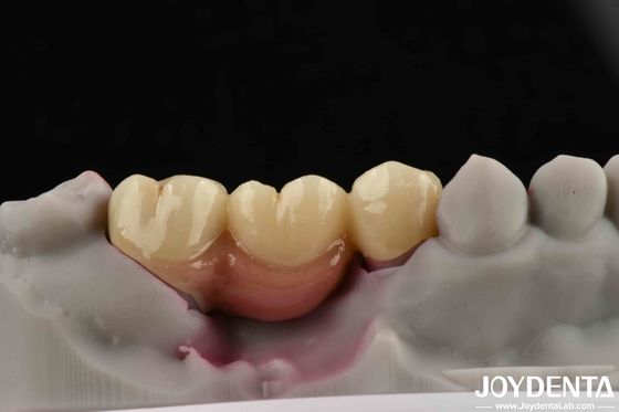 Implante Dental Personalizável Ponte e Coroa Com Apoio Para Implantes Dentários