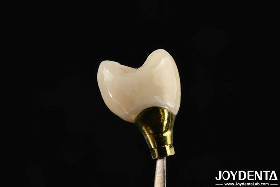 Vários tamanhos Implantação coroa e ponte para implantes dentários fortes Compatibilidade