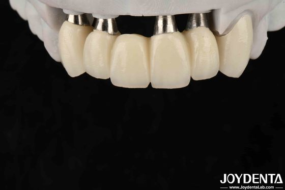 Coroa e ponte de implante personalizáveis para biocompatibilidade oral segura