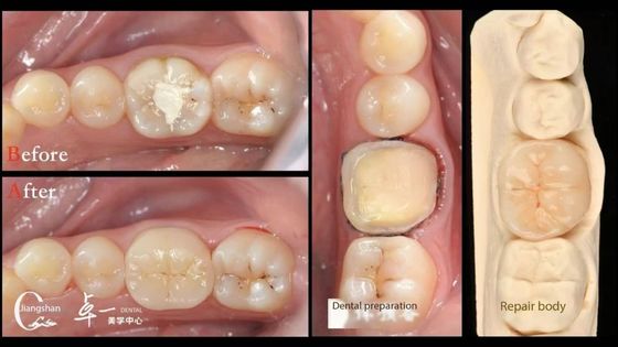Biocompatibilidade e Alta Compatibilidade com Dentes Naturais Restauração Dental Inlay Restauração