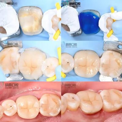 Experimente a precisão da incrustação dental acessível e branca para o ajuste perfeito