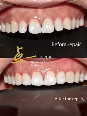 Diz olá a um sorriso impecável com facetas cosméticas, sem descoloração, sem preparação.