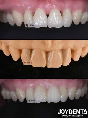 As folhas de gafanhoto são a solução perfeita para folhas dentárias translúcidas naturais