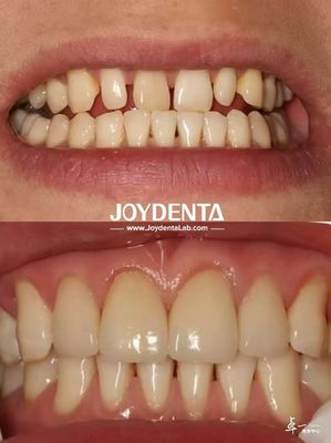 Veneers Dentários Duráveis Sem Descoloração Perfeito Para Necessidades de Sourcing B2B E Mais