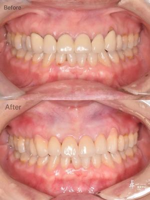 Circonia dentária de alta resistência à fratura para tecido oral seguro e compatibilidade CAD / CAM