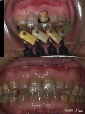 Translucidez Coroas de zircônio Tecnologia de gradiente multicamadas para translucidez ideal e biocompatibilidade a longo prazo