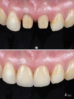 Veneers feitos com alta resistência à fratura Zirconia Dental e tecnologia de gradiente multicamadas