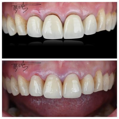 Confortáveis pontes dentárias de zircônio Transições de cor natural leves para uma experiência ideal do paciente