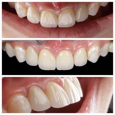 Indicação dentária anterior Veneers dentários com espessura de 0,5 mm e permeabilidade perfeita