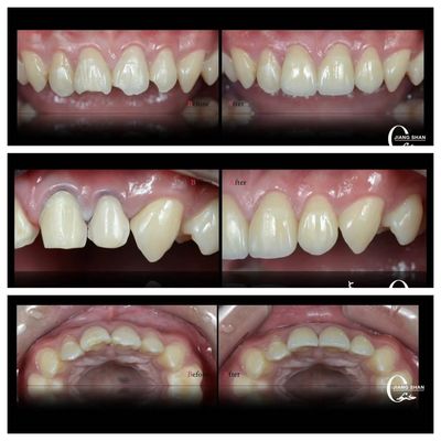 Folheados Dentários Naturais Para Um Sorriso Natural e Belo