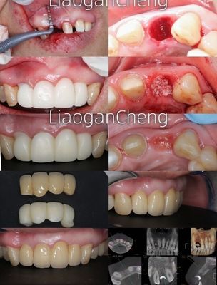 Tecnologia Gradiente Multicamadas Zirconia Dental Segura e Esteticamente agradável a longo prazo