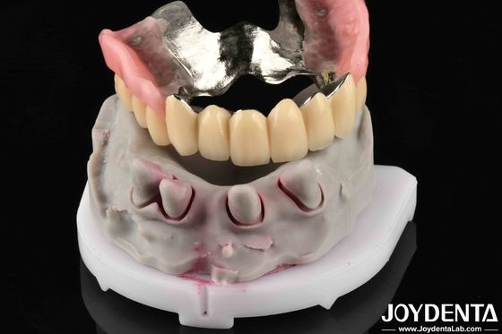 Material metálico dentário avançado para suportar as necessidades de mastigação