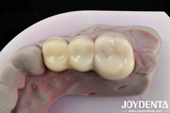 Resistência flexural 90-100 MPa garante restaurações temporárias fortes e estáveis PMMA